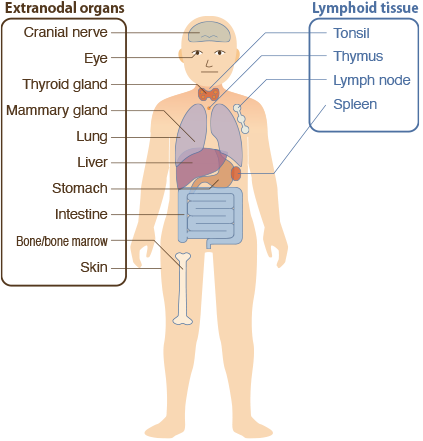 What is malignant lymphoma