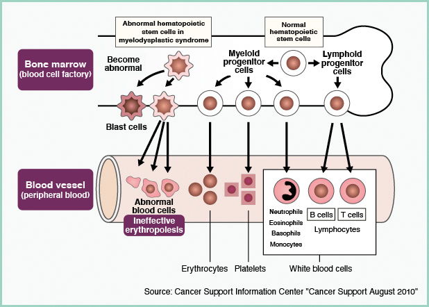 What is myelodysplastic syndrome (MDS)?